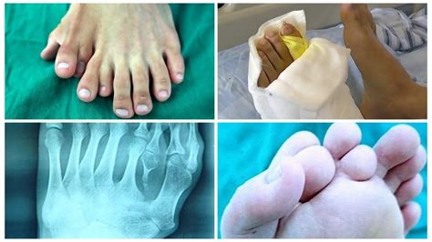 See What Chinese Man Born With Nine Toes Did To It Photos Anaedoonline