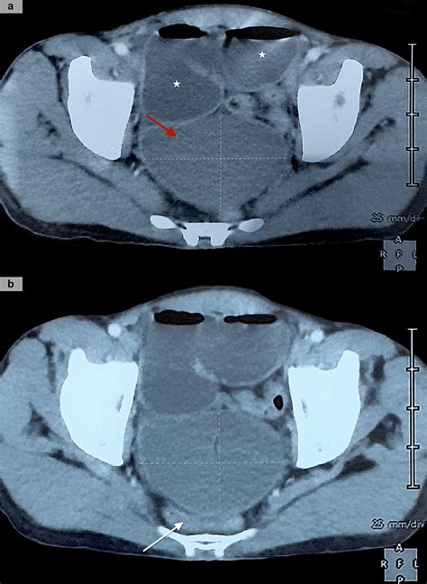 Unusual Presentation Of An Ileal Duplication Cyst A Case Report Hospinov The Platform For