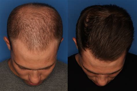 Prp For Men Treatment For Hair Loss San Diego