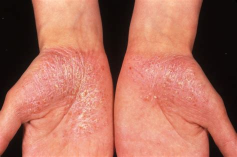 Generalized Pustular Psoriasis Signs And Symptoms