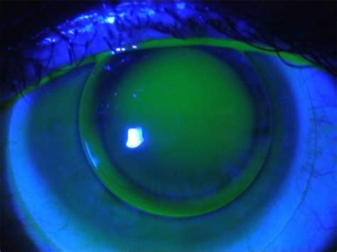 Fluorescein Pattern Of Optimal Piggyback Contact Lens Fitting