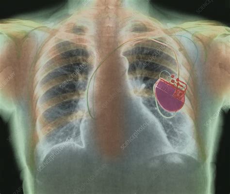 Heart Pacemaker X Ray Stock Image M5000046 Science Photo Library