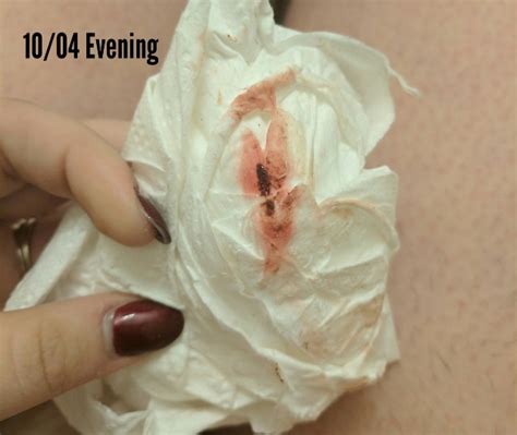 Implantation Bleeding Or Something Else Help Pls Tmi Toilet Paper