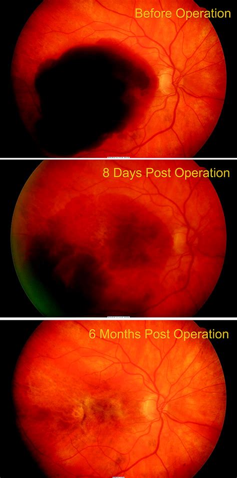 Management Of Submacular Haemorrhage In Age Related Macular
