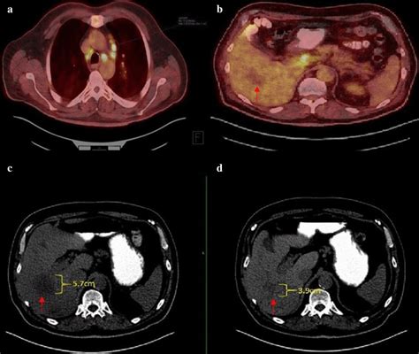 A Fdg Petct Demonstrating Hypermetabolic Mediastinal Lymph Nodes B