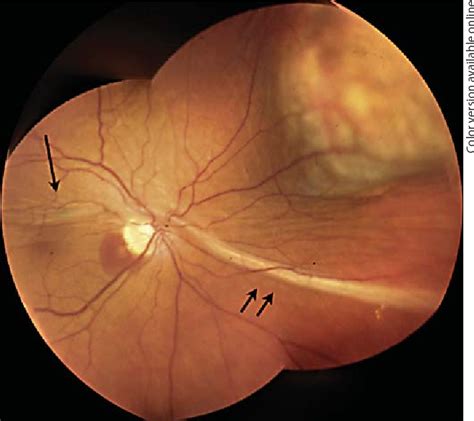 Figure 1 From Retinal Folds Following Retinal Detachment Surgery