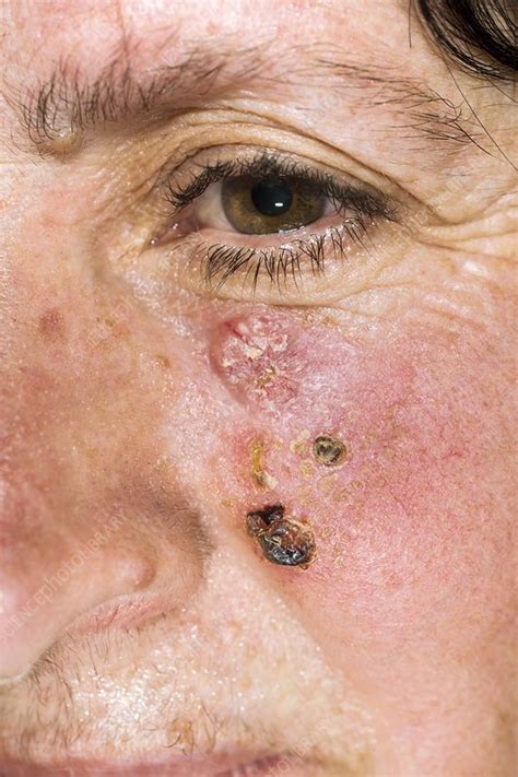 Basal Cell Skin Cancer On The Face Stock Image C0142535 Science Photo Library