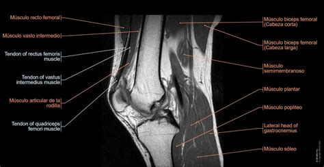 La Rodilla Irm Atlas De Anatomía En Imágenes Médicas E Anatomy