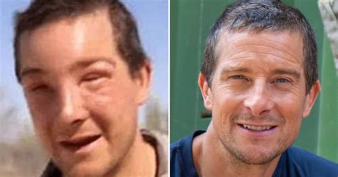 Bear Grylls Needs Medical Treatment After Suffering Severe Reaction To