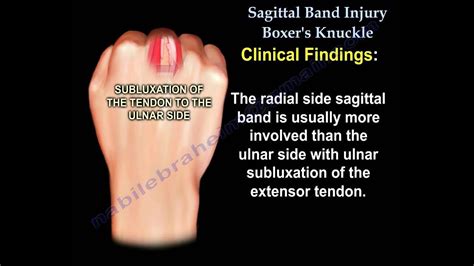 Sagittal Band Injury Boxers Knuckle Everything You Need To Know Dr
