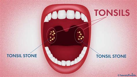 Do Dogs Have Tonsil Stones