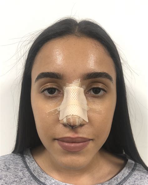 Recovery After Rhinoplasty What To Expect And When