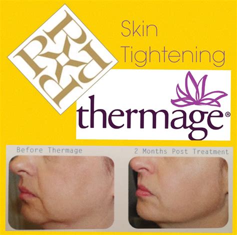 Radio Frequency Skin Tightening With Thermage At Our Knightsbridge