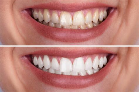 Unveiling The Secrets Of Giada Teeth Whitening Ingredients
