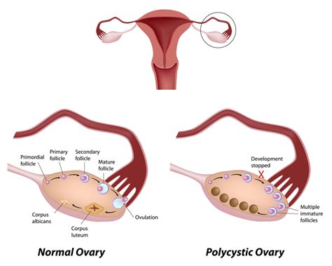 Pcos Polycystic Ovary Syndrome Tennessee Reproductive Medicine