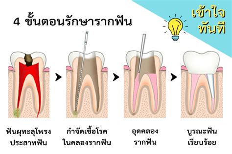 รักษารากฟัน ราคาที่คุ้มค่าถ้ามีเงื่อนไขเหมาะสม Skt Dental Center