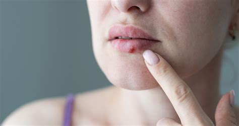 Cold Sores Causes Treatments And Prevention University Of Utah Health