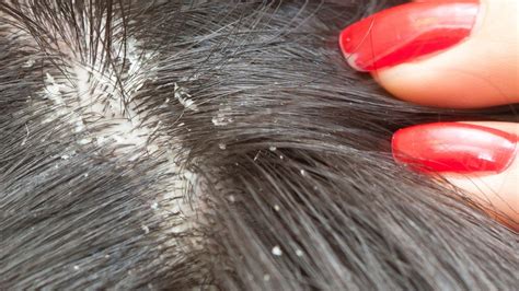 Dry Scalp Causes Like Eczema And Psoriasis Symptoms Treatments And Remedies American Celiac
