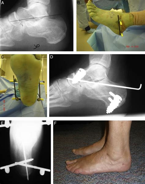 Technique For Minimally Invasive Reduction Of Calcaneal Fractures Using