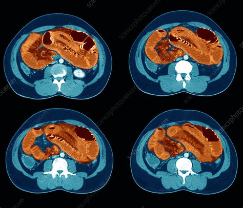 Healthy Colon Ct Scan Stock Image P5600117 Science Photo Library