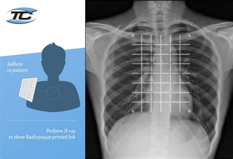 How To Boost Medical Scans And Procedures Accuracy Radiopaque Markers