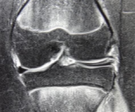 Coronal Slice Of Mri Showing Discoid Lateral Meniscus With Complex