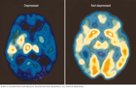Pet Scan Of The Brain For Depression Mayo Clinic