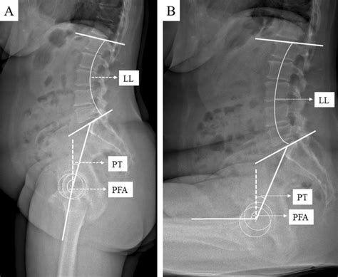 Sagittal Standing A And Sitting B Eos Radiographs Of The Spine