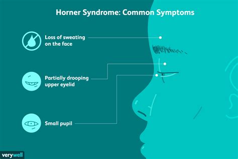 Horner Syndrome Causes Symptoms And Treatment