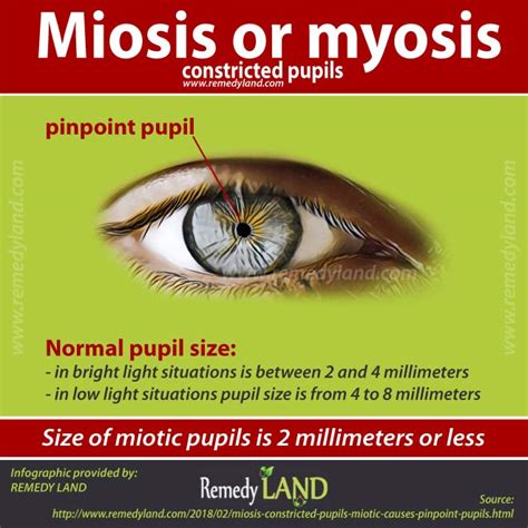 Miosis Constricted Pupils Miotic Causes Of Pinpoint