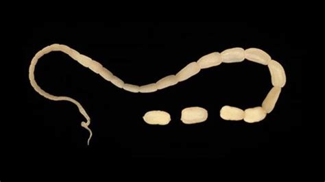 Doctors Remove 6 Foot Tapeworm Through Mans Mouth