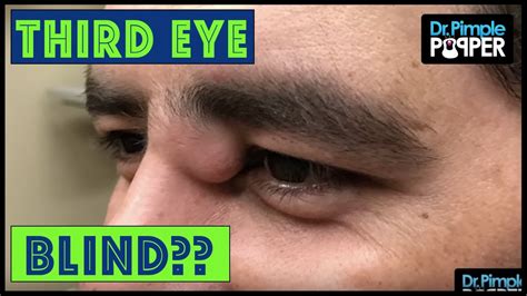 Dr Pimple Popper Squeezes Giant Cyst On Mans Eyevideo Amc
