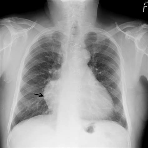 Chest X Ray With Prominent Right Cardiac Border Secondary To Dilatation My Xxx Hot Girl
