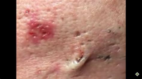LARGE Blackheads Removal #003 