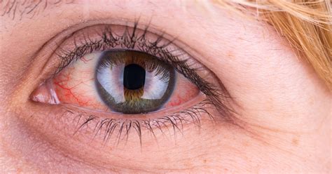 19 Causes And Treatments For Red Eyes Sjogrens Syndrome Sjogrens