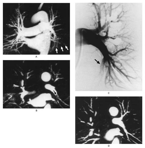 Diagnosis Of Pulmonary Embolism With Magnetic Resonance Angiography Nejm