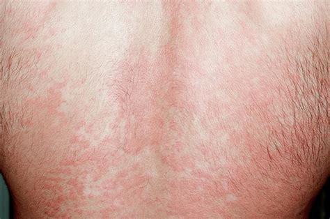 Urticaria Rash On The Back Photograph By Dr P Marazziscience Photo