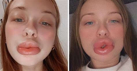 Mother Left With Massive Lips 3x The Normal Size After Getting Cheap