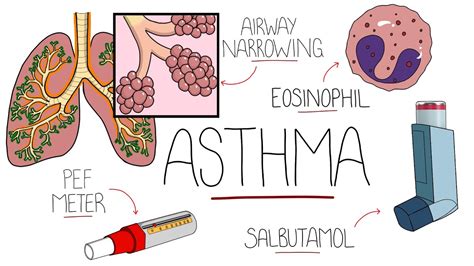 Asthma Explained Including Pathophysiology YouTube