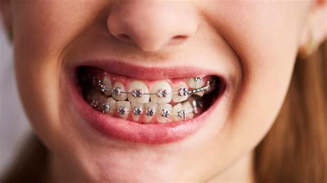 Braces Vs Aligners Expert Suggests Which Is Better For You Onlymyhealth