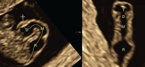 Sonographic Detection Of Fetal Abnormalities Before 11 Weeks Of