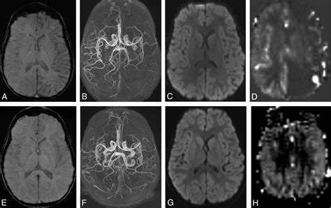 Transient Focal Neurologic Symptoms Correspond To Regional Cerebral