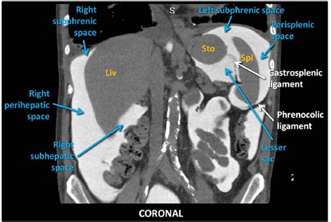 Figure 15 From Peritoneal Cavity Anatomy In Ct Peritoneography A