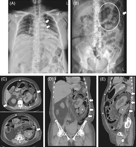 Radiological Images Of Air‐forming Retroperitoneal Abscess A Chest