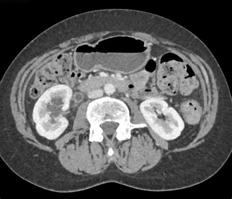 Obstructing Stone Right Ureter with Inflamed Right Ureter - Kidney Case Studies - CTisus CT Scanning
