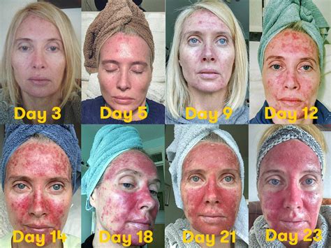These Graphic Photos Of Skin Precancer Treatment Are A Must See Self