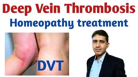Deep Vein Thrombosis In Hindi Dvt Symptoms Causes And Treatment