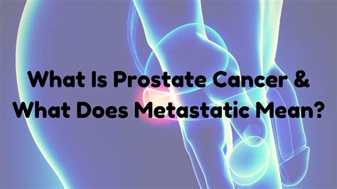 Metastatic cancer means the cancer has spread from where it started to another part of your body. What Is Prostate Cancer? What Does Metastatic Mean? - YouTube