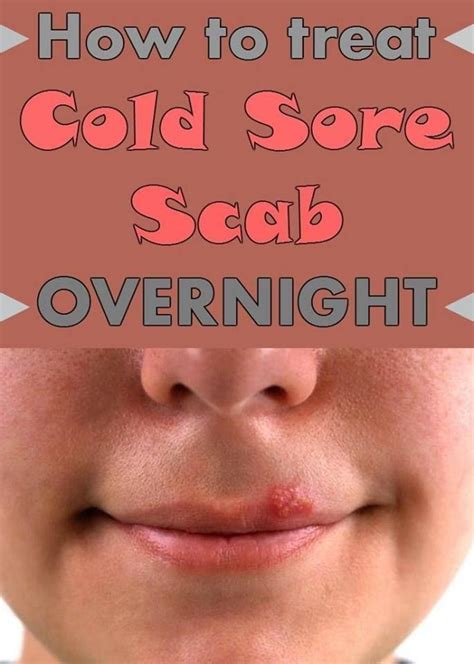 How To Get Rid Of A Scab In 2020 Cold Sore Scab Cold Sores Remedies