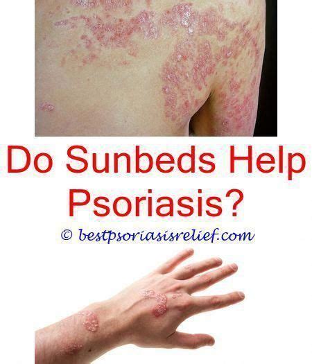 Everything You Need To Know About Psoriasis With Images Psoriasis